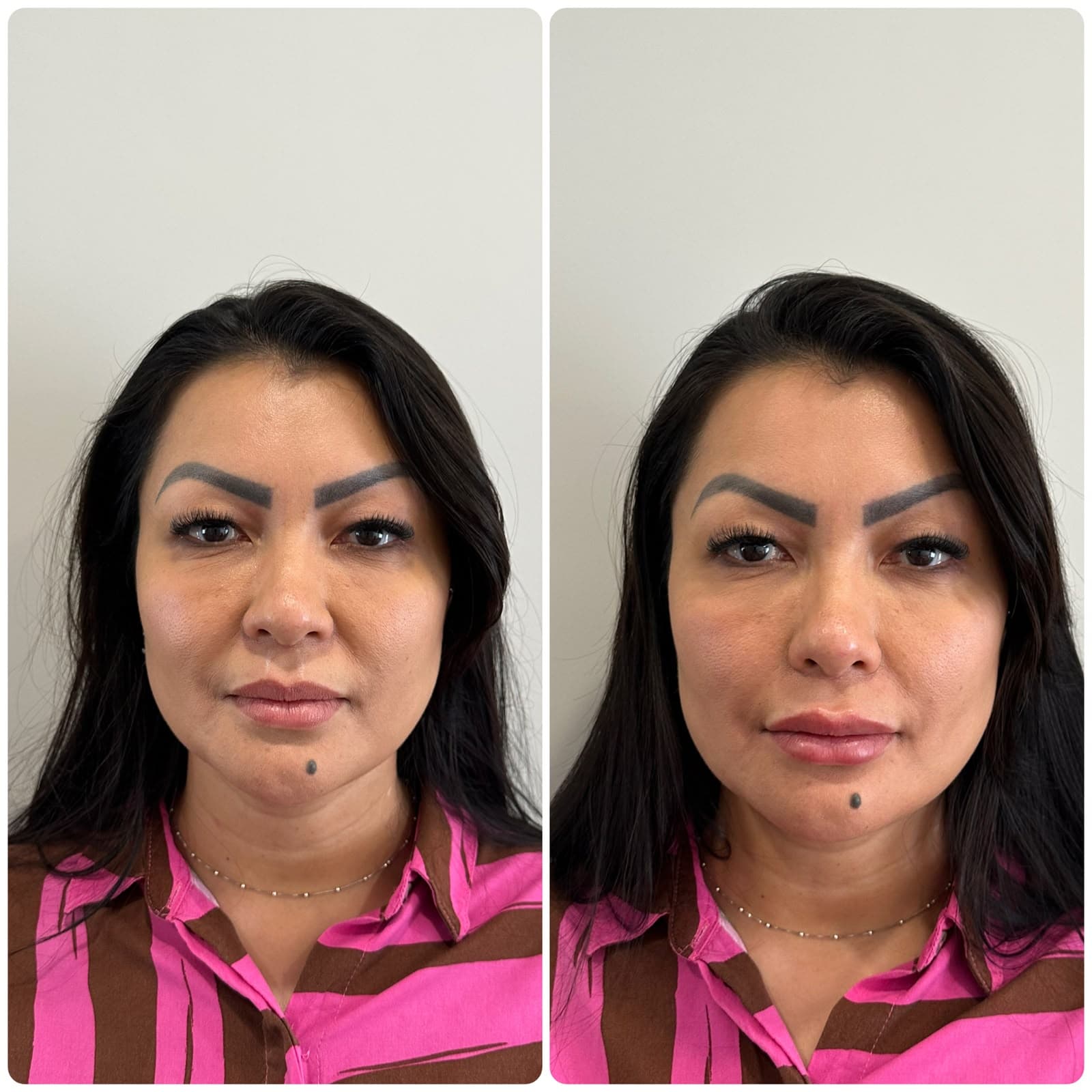 Antes e depois — paciente do Dr. Johannes Quinelato