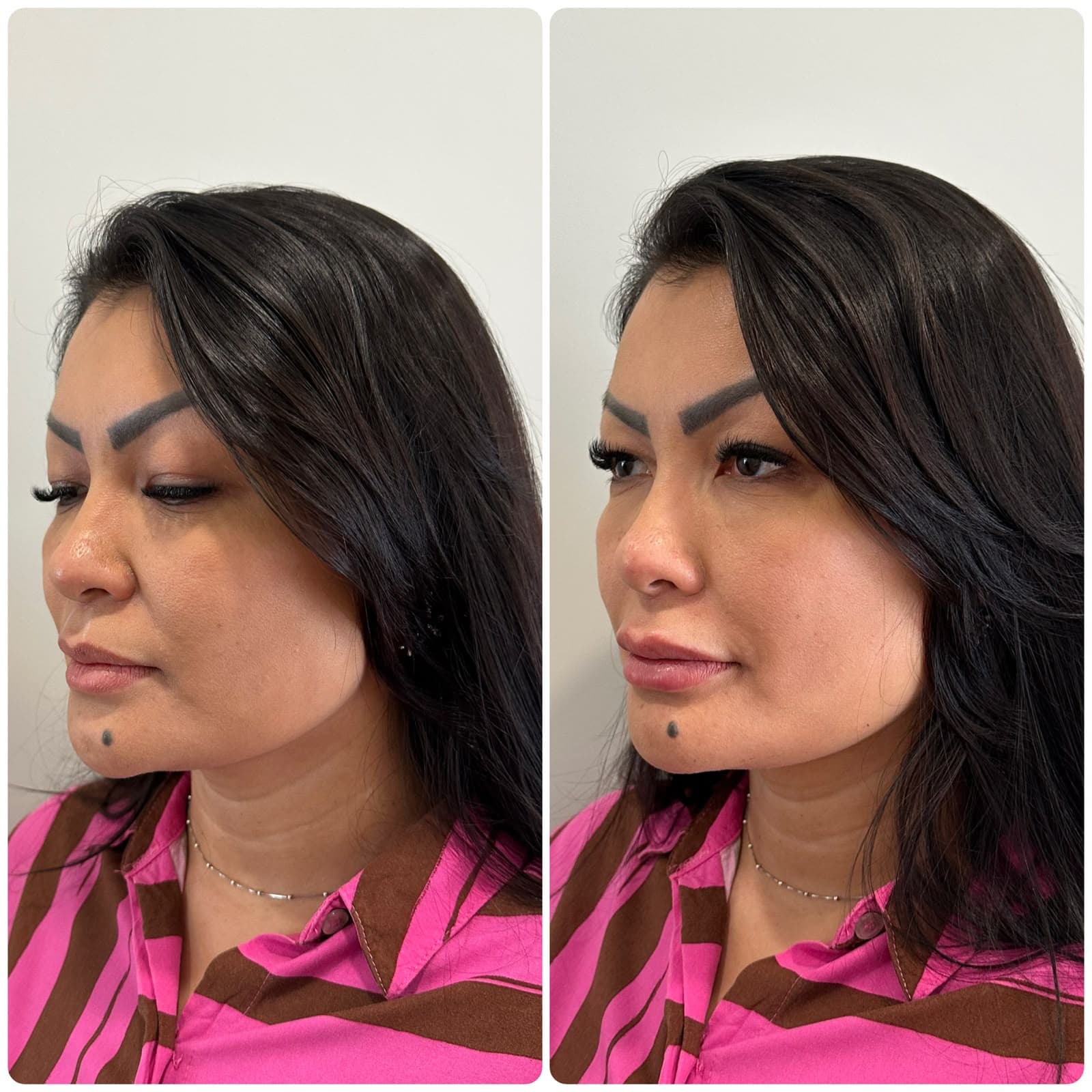 Antes e depois — paciente do Dr. Johannes Quinelato