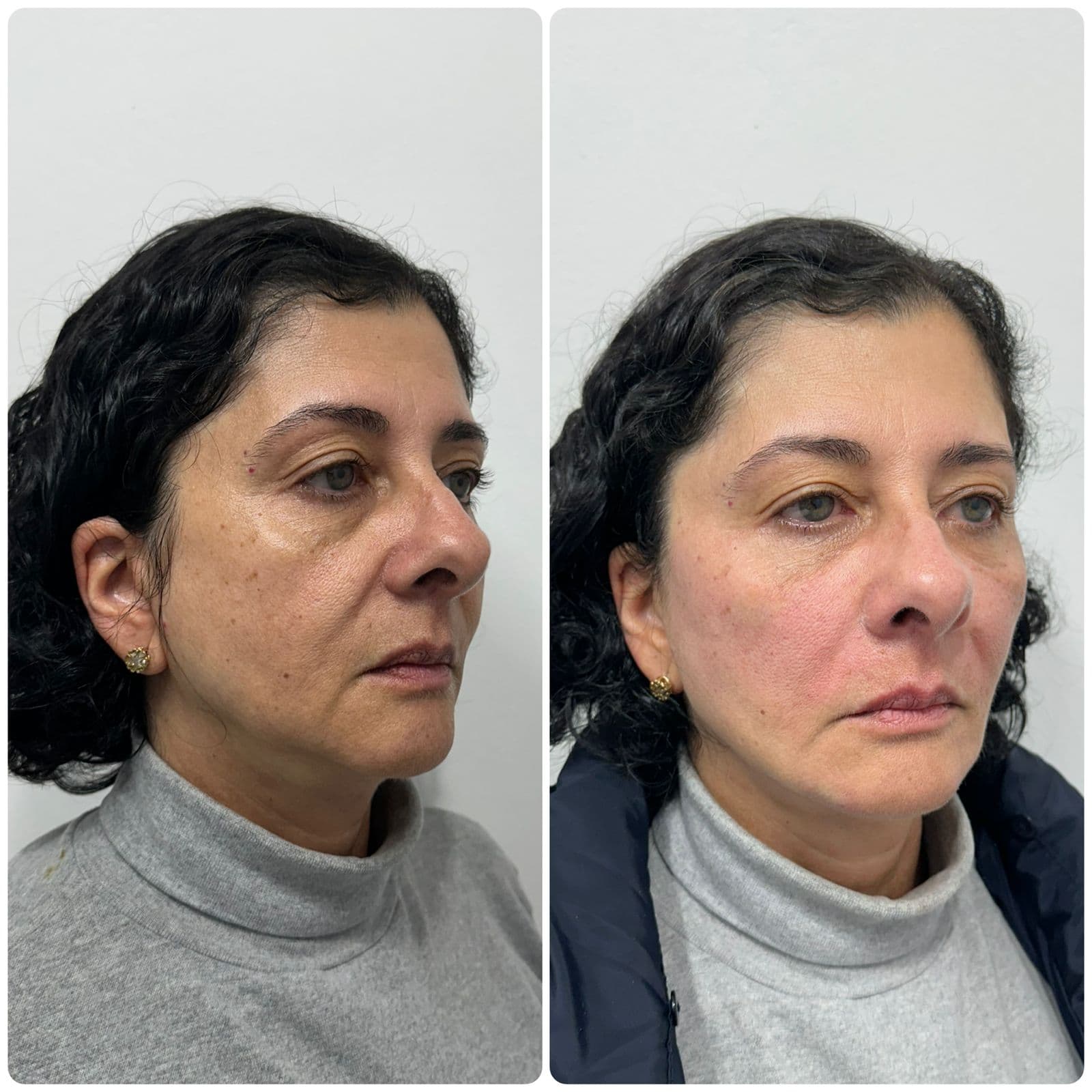 Antes e depois — paciente do Dr. Johannes Quinelato