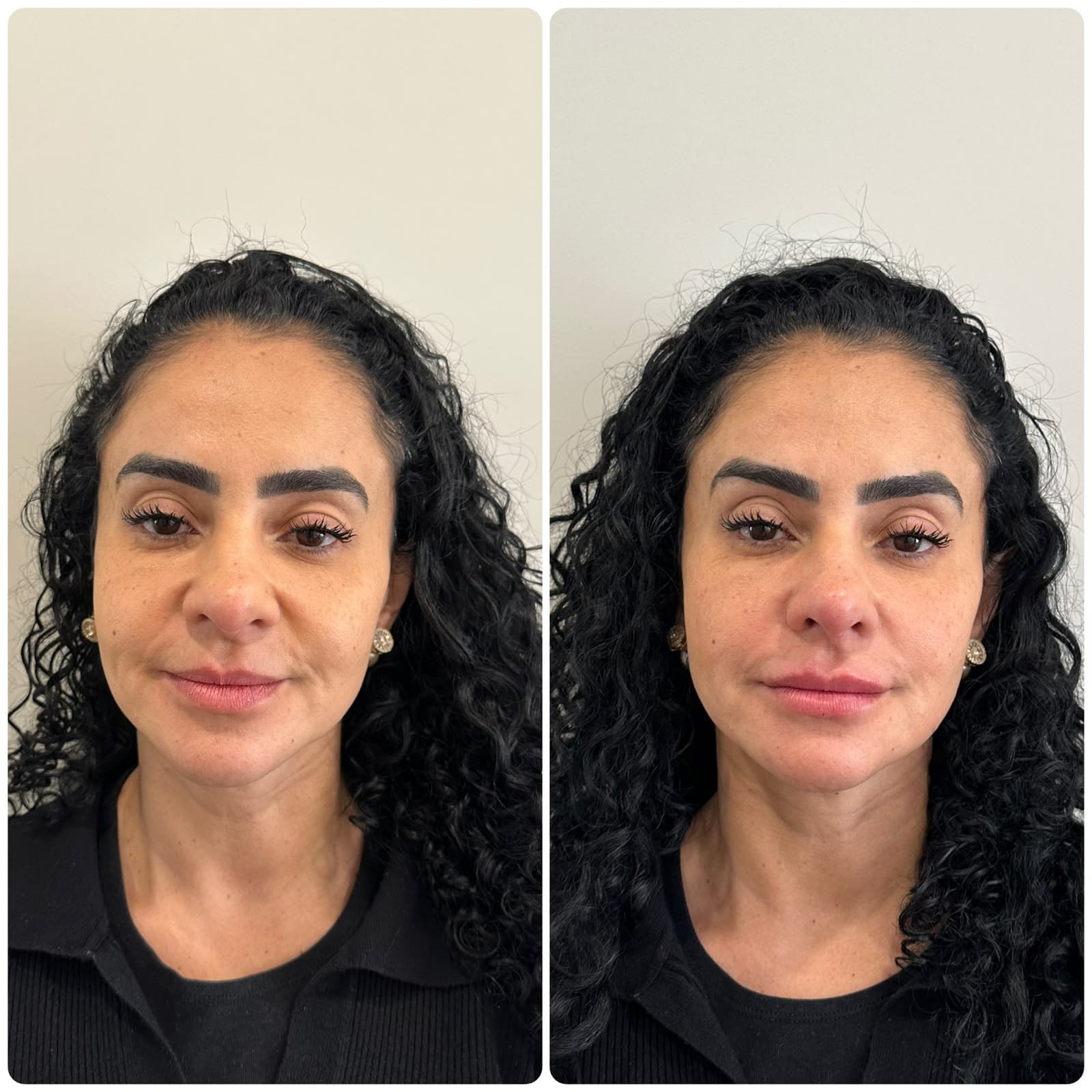 Antes e depois — paciente do Dr. Johannes Quinelato