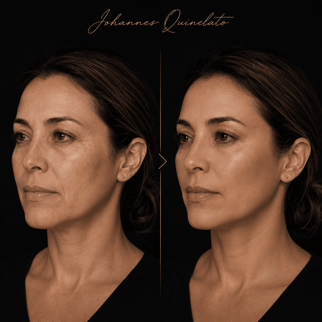 Antes e depois — harmonização orofacial por Dr. Johannes Quinelato